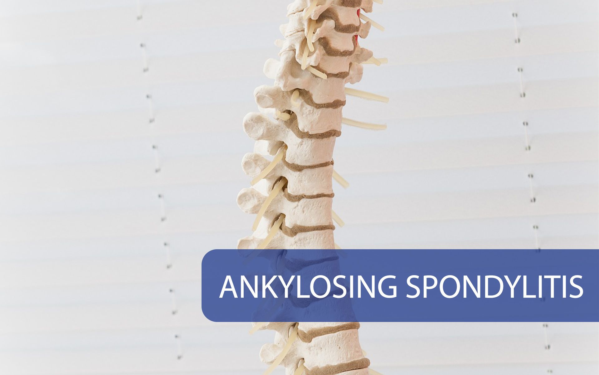 Ankylosing Spondylitis
