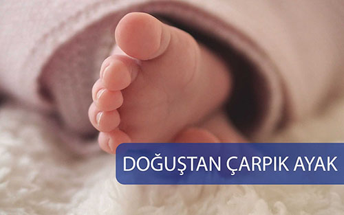Doğuştan Çarpık Ayak