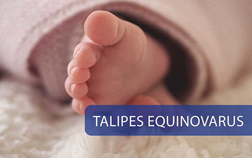 Talipes Equinovarus