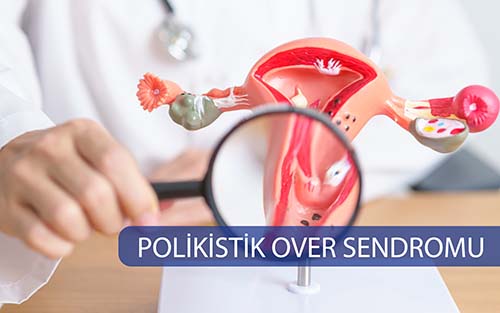 POLİKİSTİK OVER SENDROMU